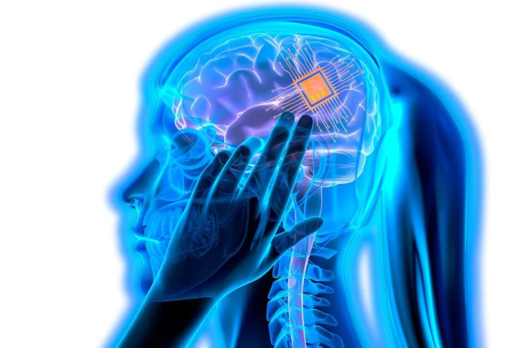 Représentation schématique d'un implant cérébral connecté à une interface technologique pour la lecture des ondes de la surface corticale.